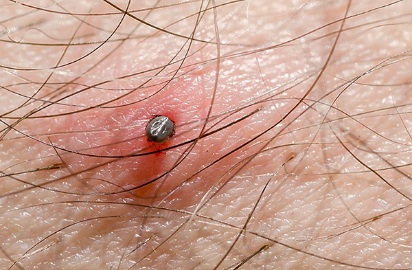 Les tiques ixodides sont porteuses d'un certain nombre de maladies infectieuses dangereuses chez l'homme et les animaux.