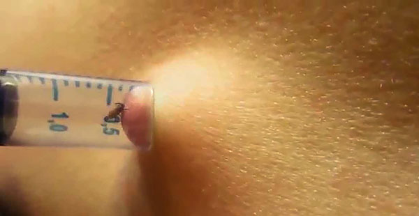 Un exemple d'extraction d'une tique avec une seringue