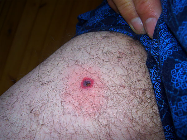 Si la tête du parasite se détache, elle doit être retirée avec une aiguille et retirée de la peau, comme une écharde.