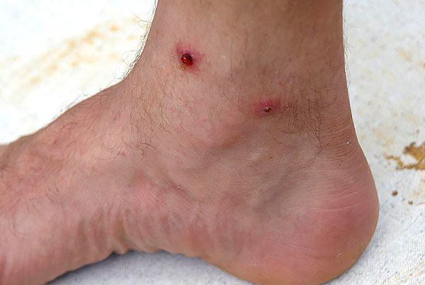 Les morsures infectées et enflammées font mal pendant longtemps et peuvent devenir des sources d'infection bactérienne dans le corps.