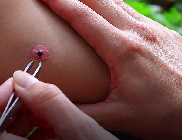 À l'endroit où les organes buccaux du parasite sont restés dans les tissus, l'inflammation et la suppuration commenceront.