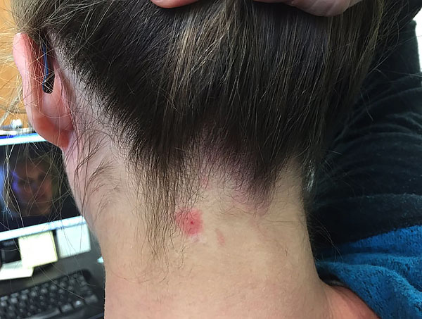 Si le parasite a sucé du sang assez longtemps, une tache rouge caractéristique et un gonflement restent au site de la piqûre.