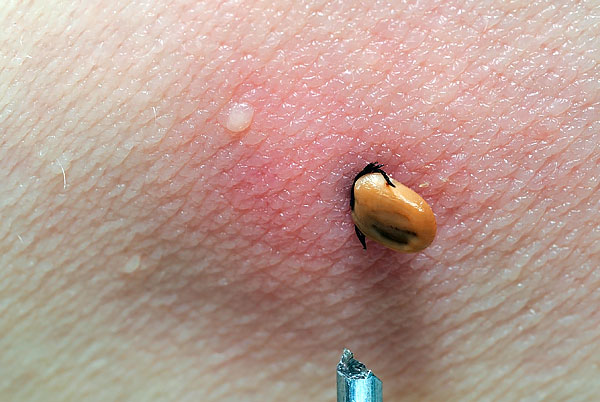 Lorsqu'elle est mordue, la tique enfonce sa tête très profondément dans les tissus et est maintenue si fermement qu'il est plus facile d'arracher son corps de la tête que d'extraire le parasite de la peau.