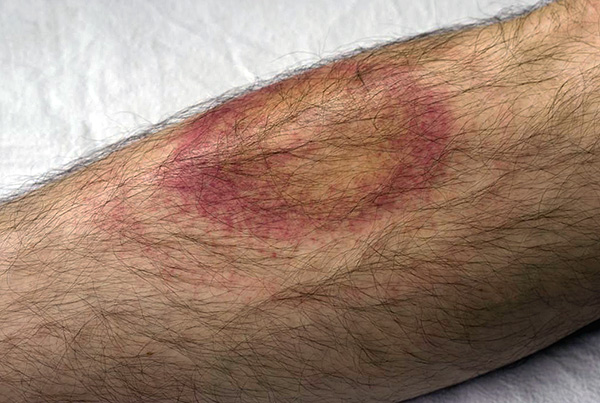 Érythème annulaire