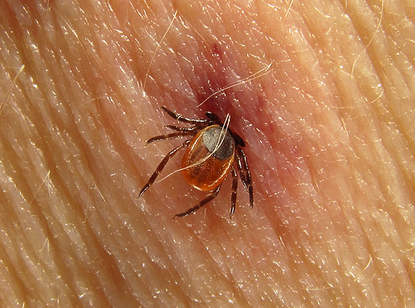 Tique Ixodid attachée à la peau humaine