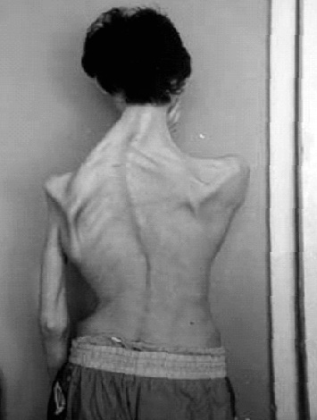 Séquelles d'encéphalite à tiques