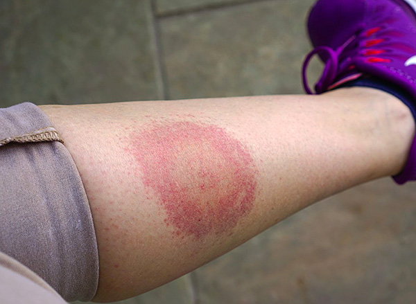 L'érythème migrant (annulaire) est une caractéristique de la maladie de Lyme.