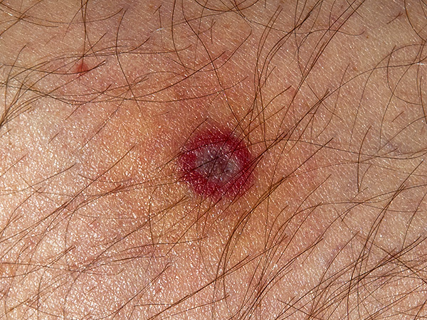 Il est logique de ne faire de la prévention d'urgence de l'encéphalite à tiques que dans les tout premiers jours après la morsure, puis cette mesure ne sera plus efficace.