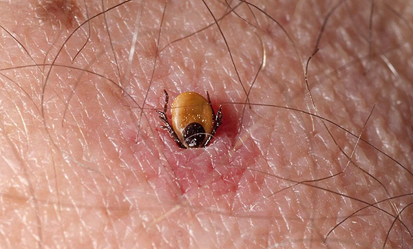 La tique a creusé la peau humaine.