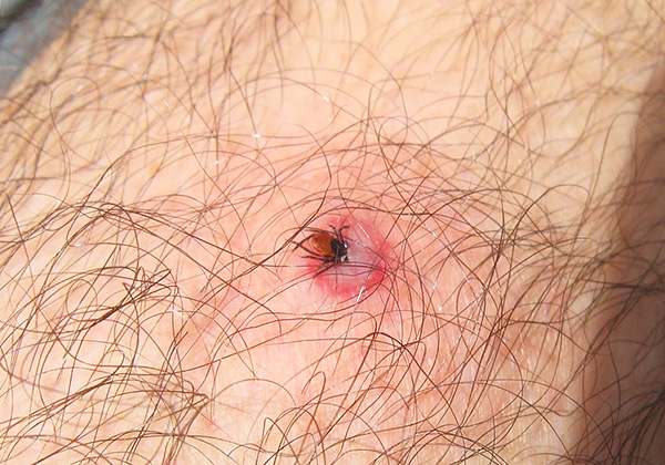 Ces parasites sont capables de véhiculer des agents pathogènes très dangereux pour l'homme...