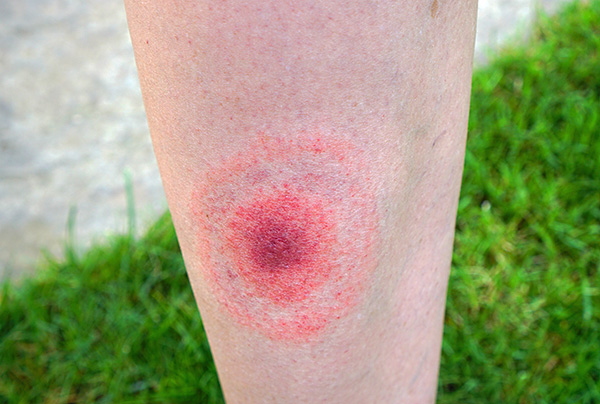 C'est souvent à cela que ressemble la piqûre d'une tique de la borréliose.