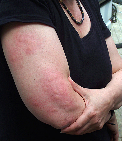 Voici à quoi ressemblent les marques de piqûres d'insectes fraîches.