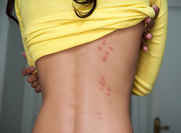 Les piqûres de punaises de lit s'alignent souvent en traces caractéristiques sur le corps, puisque chaque individu mord généralement plusieurs fois.