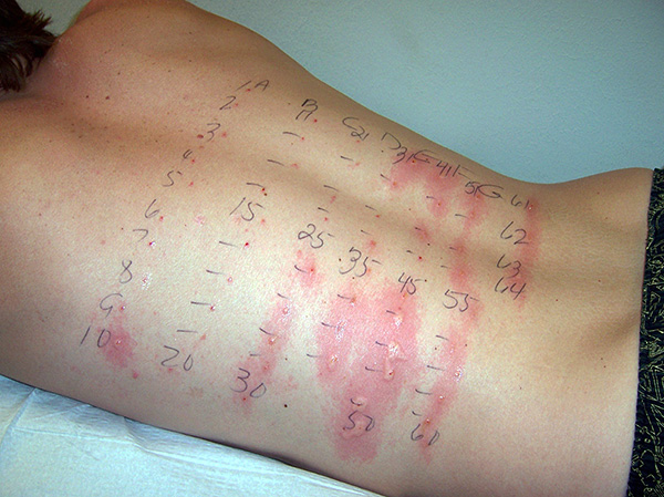 De tels tests vous permettent de déterminer avec précision quelles substances sont allergènes pour un organisme donné.