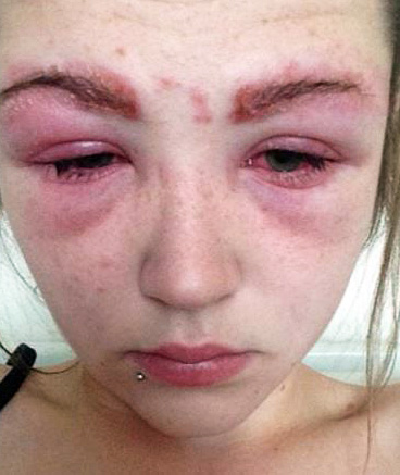 Une réaction allergique est associée à une réponse excessive du système immunitaire à l'action d'un allergène.