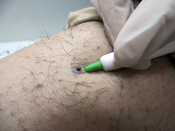 La boucle est jetée sur la tique, après quoi elle est resserrée ...