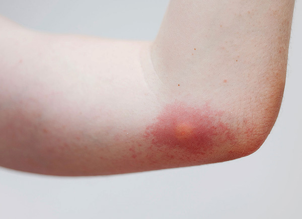 Avec le retrait correct et rapide de la tique, une bosse caractéristique ne se forme pas sur le site de la morsure.