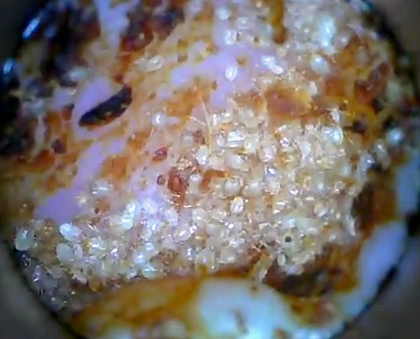 Accumulation massive d'acariens dans le conduit auditif.