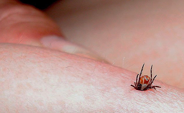 Tique ixodide dans la peau humaine.