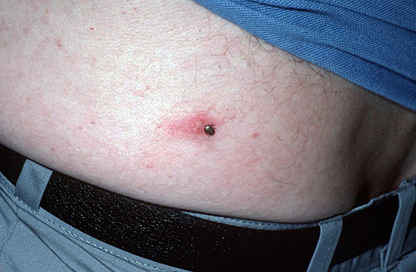 Chaque année en Russie, environ 2000 personnes tombent malades de l'encéphalite à tiques...