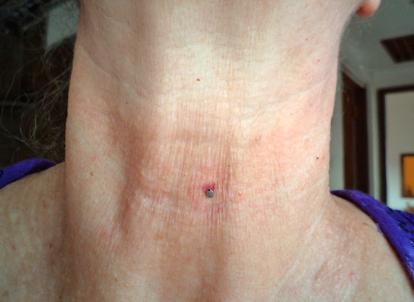 S'il existe un réel danger de se faire piquer par une tique infectée, la vaccination peut sauver la santé et même la vie d'une personne.