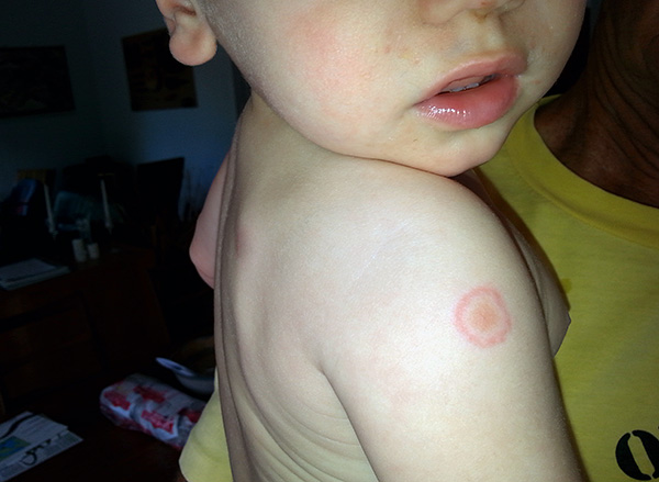 La photographie montre une trace de morsure de tique sur la main de l'enfant.