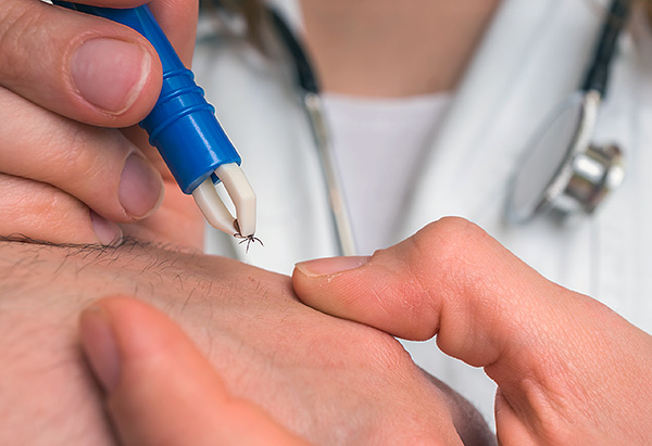 Pince à épiler pour enlever les tiques