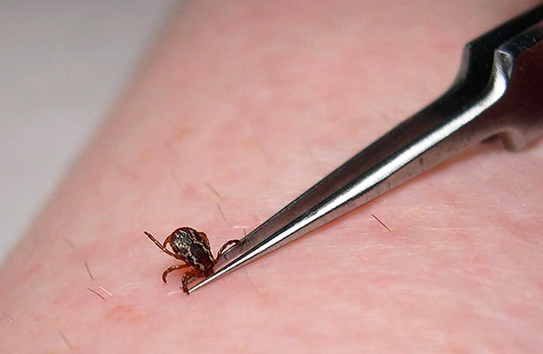 Utiliser une pince à ongles ordinaire pour retirer un suceur de sang n'est pas très pratique.