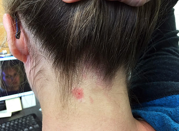 La plaie laissée après une morsure de tique doit être traitée avec un antiseptique.