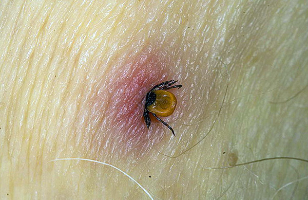 La structure particulière de l'appareil buccal des tiques ixodides leur permet d'être très fermement maintenues dans la peau de l'hôte après une morsure.