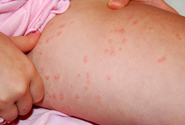 Piqûres de poux de lin