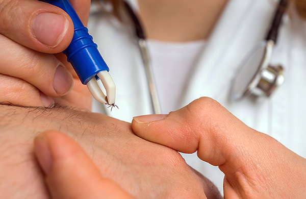 Vous pouvez également supprimer le parasite à l'aide d'une pince spéciale.