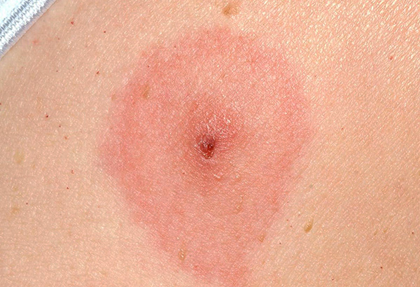 La plaie après la morsure doit être désinfectée.