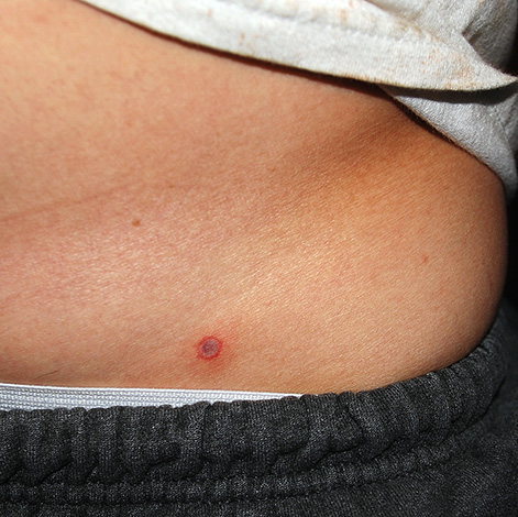 L'état de la victime de la morsure doit être surveillé attentivement pendant au moins un mois.