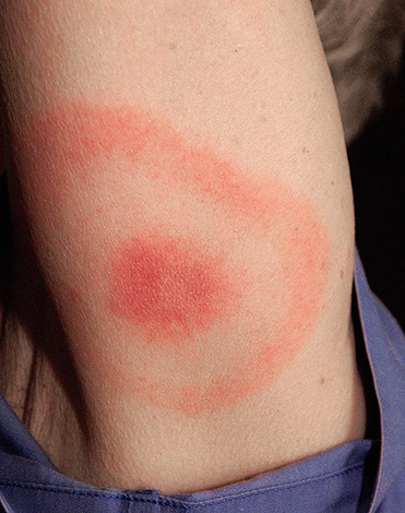 Anneau érythème migrateur.