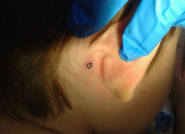 La tique coincée derrière l'oreille de l'enfant.