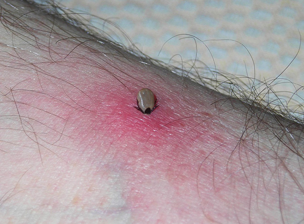 Plus la tique attachée est sur le corps, plus elle injecte de salive infectée sous la peau.