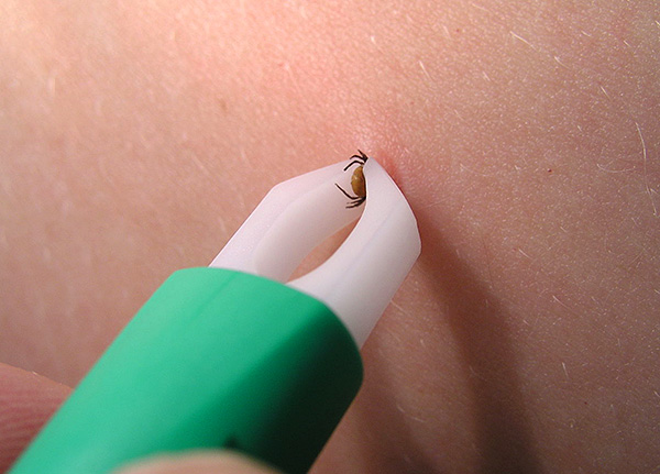 Pince à épiler spéciale pour enlever les tiques.