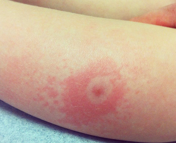 Aspect typique d'une piqûre de tique