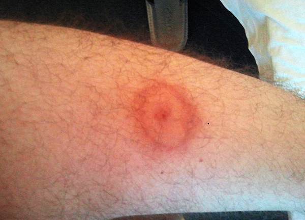 Morsure de tique fraîche