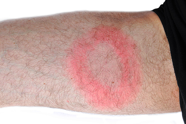 Un autre exemple d'érythème migrant.