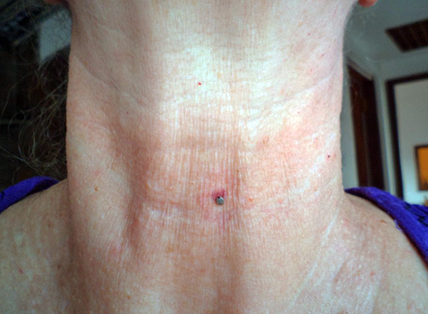 La tique coincée dans la gorge