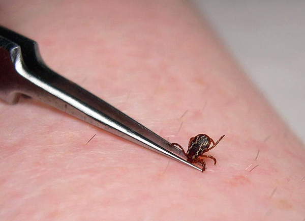 Plus le parasite attaché est retiré rapidement, moins il aura le temps d'injecter de salive infectée sous la peau.