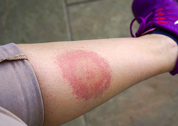 Un autre exemple de ce à quoi pourrait ressembler une morsure de tique borréliose.