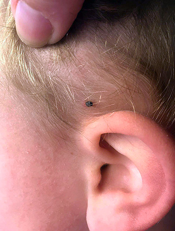 Un endroit préféré pour sucer le parasite chez les enfants est près des oreilles.