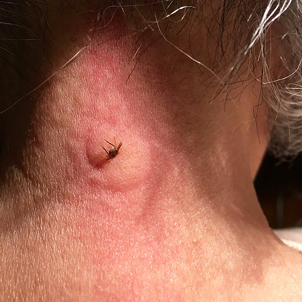 Certaines personnes peuvent avoir une réaction allergique à la morsure.