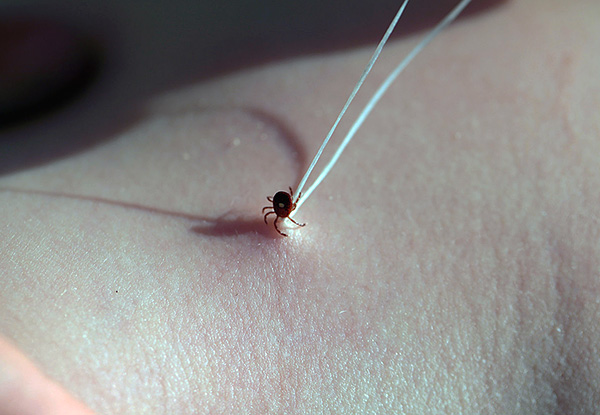 Le parasite attaché peut être enlevé avec un fil normal.