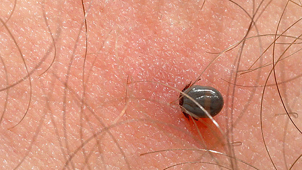 Immédiatement après l'aspiration, plus la tique aspire le sang longtemps, plus elle s'enfonce profondément dans la peau.