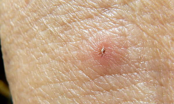 Normalement, après l'élimination du parasite, la plaie au site de la morsure guérit rapidement.