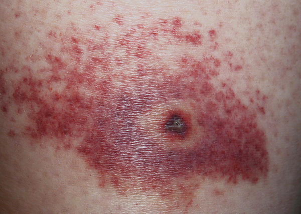 Si la tête du parasite reste dans la plaie, la cicatrisation peut être retardée ...